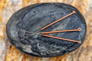 Alternative medicine with acupuncture Alternative medicine with acupuncture