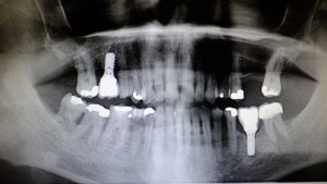 Dentist office 6/30/2020 64 year old man's X-ray showing twi dental implants and numerous fillings Dentist office 6/30/2020 64 year old man's X-ray showing twi dental implants and numerous fillings