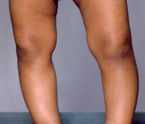 Rickets Children Legs