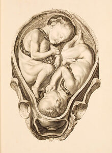 A illustration of twins in utero from A Set of Anatomical Tables, with Explanations, and an Abridgement, of the Practice of Midwifery by William Smellie, 1754.