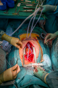 Heart valve replacement surgery, operating room,