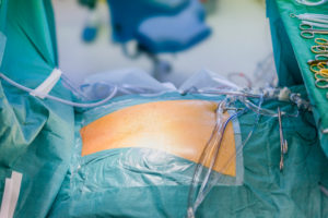 Patient prepped for heart valve replacement surgery, operating room,