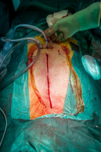 Heart valve replacement surgery, operating room,
