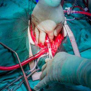 Heart valve replacement surgery, operating room,