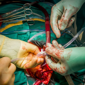 Heart valve replacement surgery, operating room,