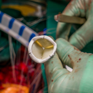 Heart valve replacement surgery, operating room,