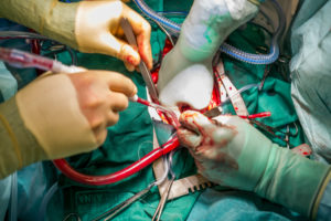 Heart valve replacement surgery, operating room,