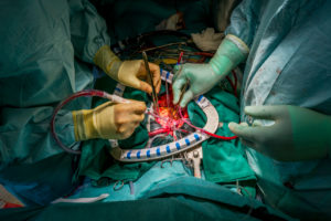 Heart valve replacement surgery, operating room,