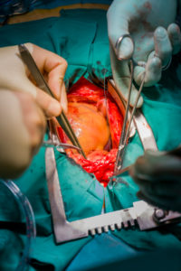 Heart valve replacement surgery, operating room,