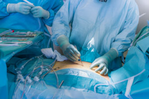 Surgeon making incision- Heart valve replacement surgery, operating room,
