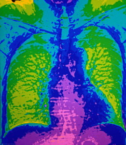 CAT scan of chest and lung.