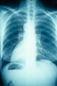 Chest x-ray