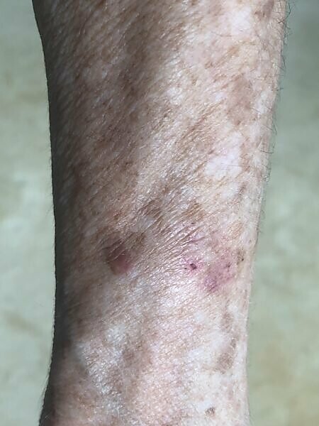 Bildagentur Mauritius Images Age Spots On The Forearm Of A 72 Year Old Woman