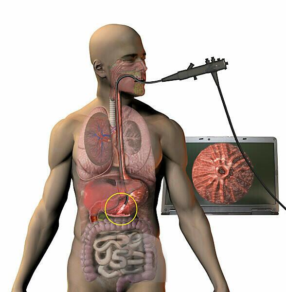 Medical illustration detailing thoracic outlet syndrome. - SuperStock