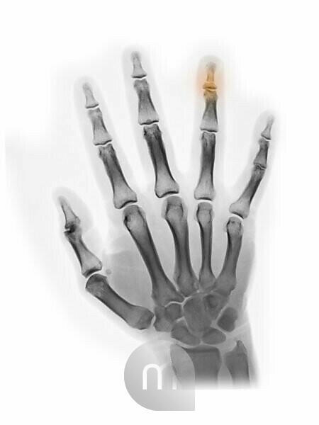 X-ray showing bone chip on right ring finger