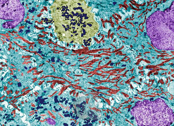 Bildagentur Mauritius Images Color Enhanced Transmission Electron Microscope Tem Micrograph Showing Melanin Granules Dark Blue In A Melanocyte Yellow And In Several Keratinocytes Light Blue With Bundles Of Keratin Filaments Red