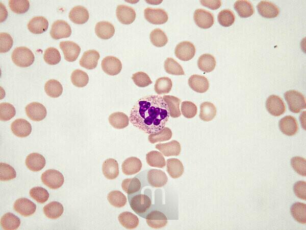 Hypersegmented Neutrophils How Many Lobes